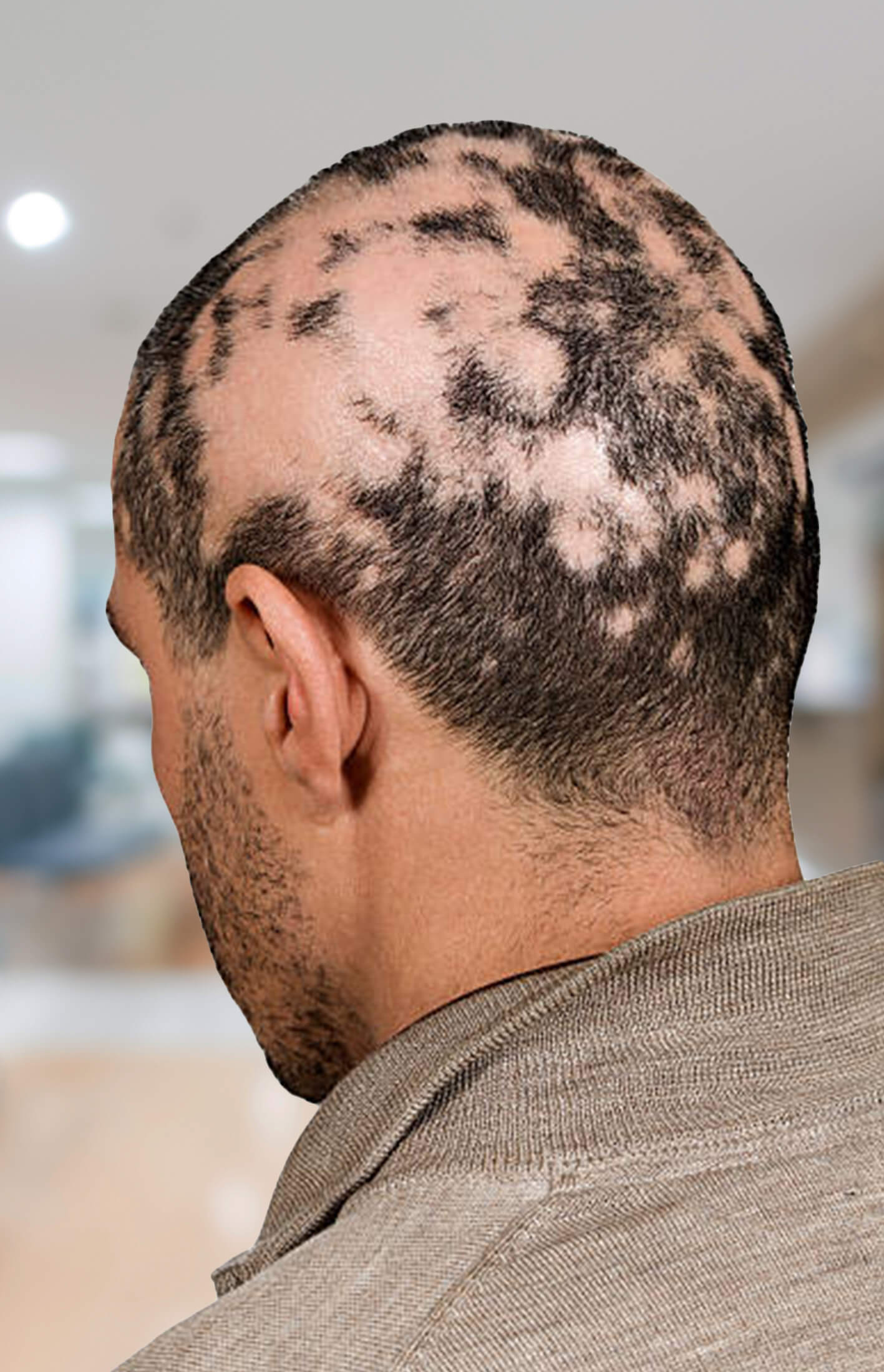 Alopecia treatment results at ryan